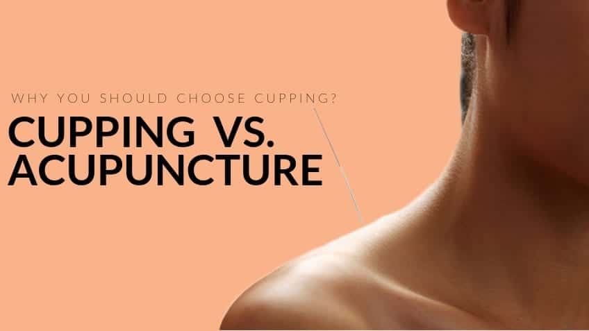 Cupping vs. Acupuncture 
